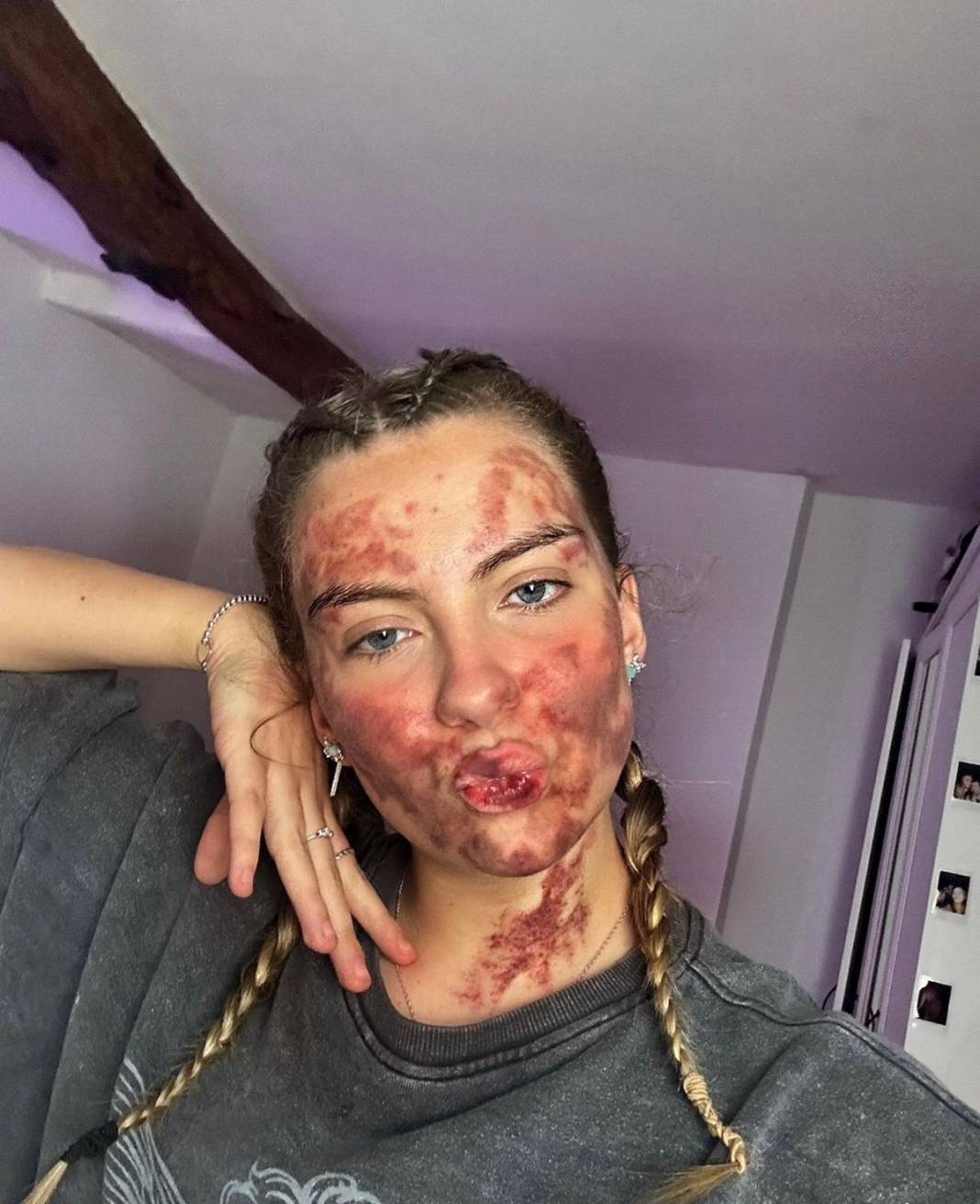 Basit bir uçuk zannetti, korkunç hastalığa yakalandı! Doktorlar bile teşhis koyamadı 1